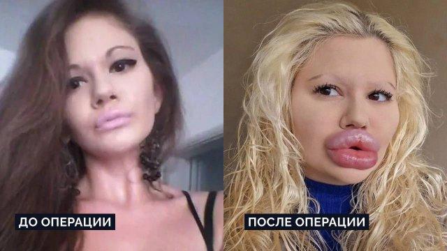 Владелица самых больших губ в мире Андреа Иванова