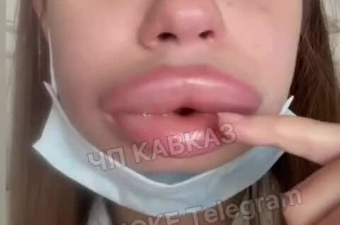 
        Девушка из&nbsp;Владикавказа хотела &laquo;сдуть&raquo; накаченные губы, а&nbsp;они&nbsp;стали только больше: начался сильнейший отек Квинке    