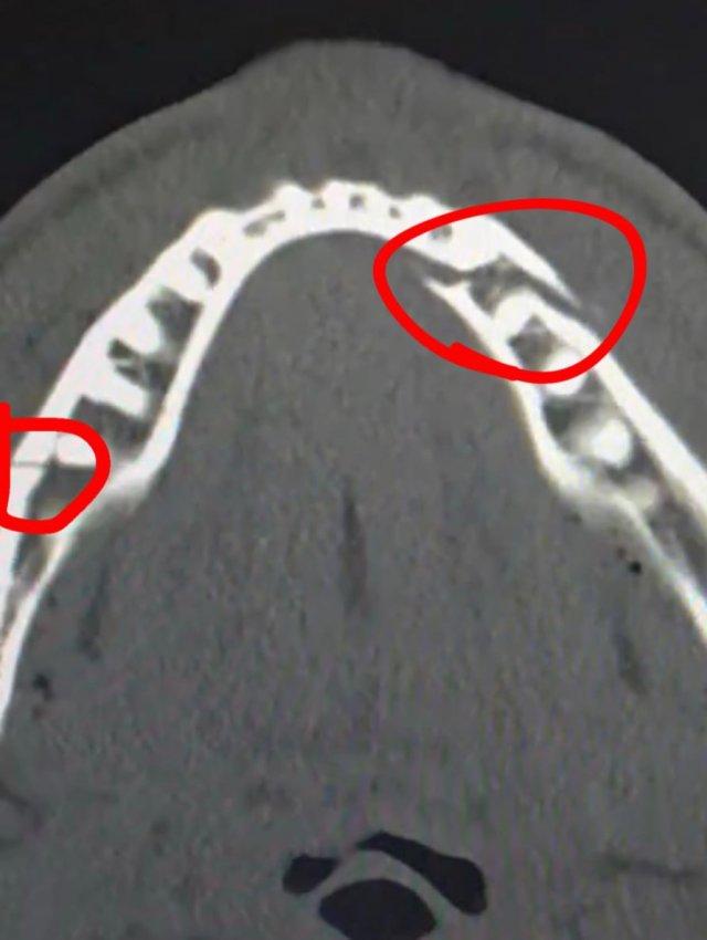 Энтони Джошуа нокаутировал блогера Джейка Пола и сломал ему челюсть в двух местах