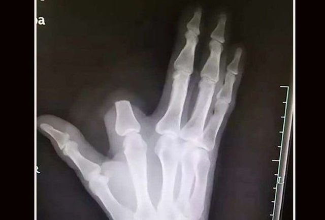 Фейл дня: мужчина отрезал себе палец после укуса змеи, но этим дело не закончилось