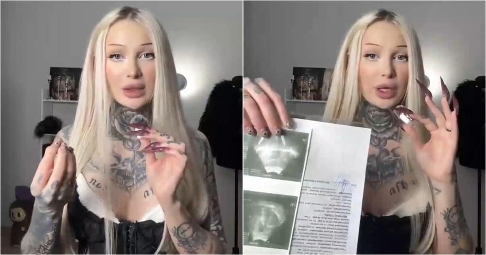 Лечение акне привело к костному наросту на ноге у девушки
Лечение акне привело к костному наросту на ноге у девушки