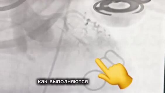 
        Сердце остановилось на&nbsp;50&nbsp;минут: хирурги восстановили кровоток и&nbsp;спасли пациентку    