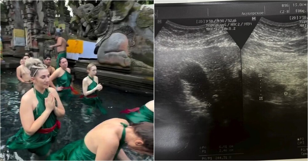 Турист год лечился от заразы, которую подхватил в «самом святом месте» на Бали
Турист год лечился от заразы, которую подхватил в «самом святом месте» на Бали