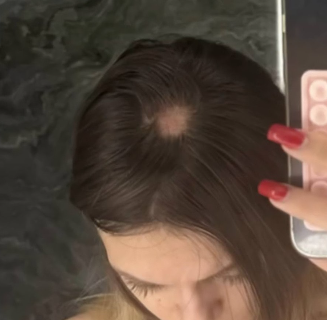 Облысение из-за шапки с маркетплейса