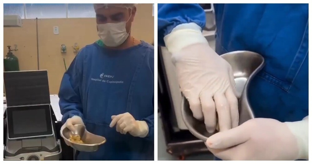 
        Медики извлекли десятки камней из&nbsp;мочевого пузыря любителя сладкой газировки    