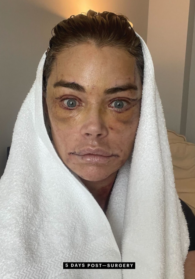 Дениз Ричардс в 55 лет сделала полную подтяжку лица и показала впечатляющий результат